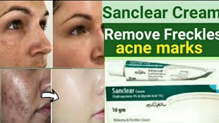 How to Remove MelasmaFreckles and pimples Marks  Sanclear Cream Review  Uses [upl. by Sitruc]