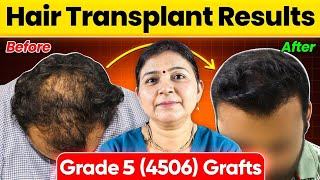 Best Hair Transplant in Agra 4506 Grafts Norwood Grade 5 Hair Loss at Saraswat Hospital India [upl. by Atonsah]