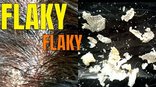 BIG FLAKES  Scalp Psoriasis Removal [upl. by Ahsilrac]