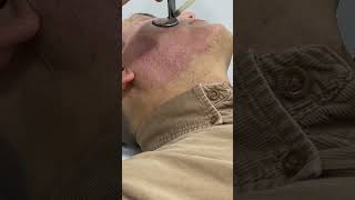 Erase Scars Fast with CO2 Fractional Laser Treatment shortvideo scarremoval [upl. by Yaresed]