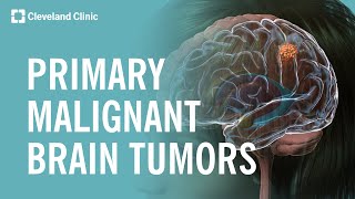 What Are Primary Malignant Brain Tumors [upl. by Lonergan]