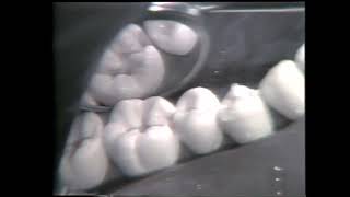 688 Class II Mesio Occlusal Cavity Preparation for Amalgam [upl. by Imtiaz90]