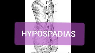 Hypospadias [upl. by Ahrendt]