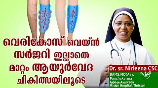 വെരികോസ് വെയ്ൻ സർജറി ഇല്ലാതെ മാറ്റം ആയുർവേദ ചികിത്സയിലൂടെ  Dr Sr Nirleena CSC ദേഹം ദേവാലയം Epi10 [upl. by Montana973]