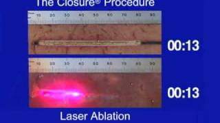 Tissue Thermal Ablation Pattern of ClosureFAST vs Laser [upl. by Enairda20]