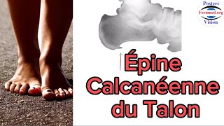 Épine Calcanéenne au Talon douleurs du pied fasciite de Aponévrose plantaire [upl. by Noslien]