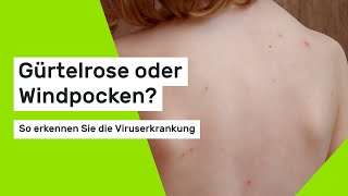 Gürtelrose oder Windpocken So erkennen Sie die Viruserkrankung [upl. by Absalom]