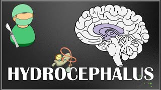 Hydrocephalus  Causes Types Signs and Symptoms Pathophysiology Diagnosis and Treatment [upl. by Anirol]