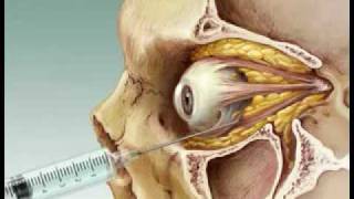 Eye Anesthesia Retrobulbar block [upl. by Munson165]