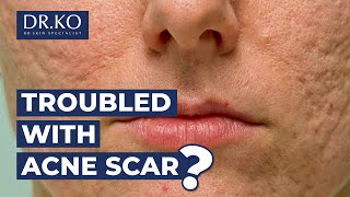 Acne Scars Treatment at Dr Ko [upl. by Nojram480]