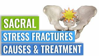 Sacral Stress Fractures  Causes amp Treatment [upl. by Meares681]