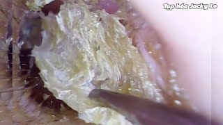 Ear Wax Removal 157 Ears itch so much I cant sleep  Earwax is wet and sticky  Ear Cleaning ASMR [upl. by Akihsat]