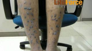 Severe Hypertrophic Lichen Planus with Severe Lichenification on Legs Treated at Life Force [upl. by Atikam]