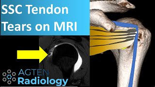 Subscapularis Tendon Tears on MRI [upl. by Lletnuahs]