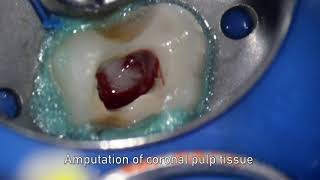 MTA pulpotomy – Video abstract ID 134315 [upl. by Nwadahs]