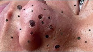 Acne treatment Blackhead remove with Spa Loan [upl. by Akiraa248]