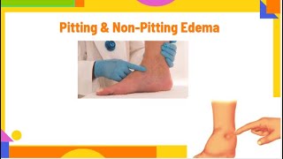 pitting amp nonpitting edema  edema types and causes  edema  PhysiotherapyKnowledge [upl. by Erhart]