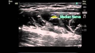 How to Ultrasound Guided Axillary Brachial Plexus Nerve Block [upl. by Biddie121]