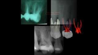 Primer molar superior [upl. by Katerine]