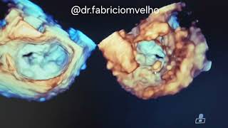 Necrose caseosa no anel mitral Componente móvel em face Ventricular [upl. by Esiralc]