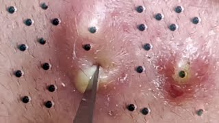 Relax Every Day With Loan Nguyen Spa  Acne Treatment Pimple Popping 49 [upl. by Michale]