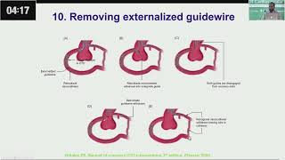 Retrograde CTO PCI Tips amp Tricks Wire Externalization by Dr Aftab khan [upl. by Yttam218]