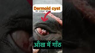 Dermoid cyst l dr Umar khan [upl. by Sheply]