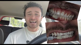 My Experience with Enlighten Teeth Whitening Did I reach for B1 shade Did I have any sensitivity [upl. by Dlanigger694]