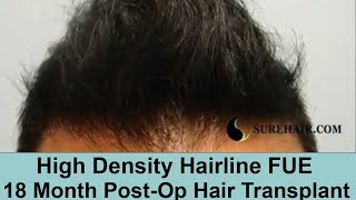 Norwood 3  18 Months PostOp 2000 Graft FUE Hair Transplant [upl. by Suivatram]