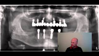 Oberkiefer Implantate auch ohne Knochenaufbau möglich [upl. by Edivad]