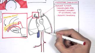 Lung Carcinoma Lung cancer [upl. by Querida]