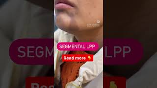 Segmental lichen Planus Pigmentosus Treatment drashimagoel skincare parisaskinclinic [upl. by Ettinger521]