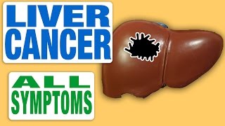 Liver Cancer  All Symptoms [upl. by Claudell267]