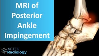 Posterior ankle impingement on MRI [upl. by Neeliak728]