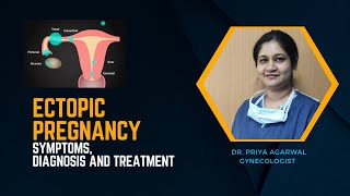 Ectopic pregnancy  Symptoms and Treatment [upl. by Eitsyrc]