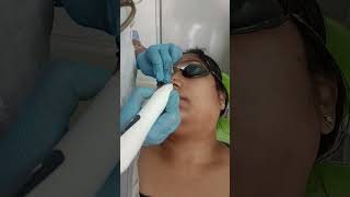 mole removal 7974419997 [upl. by Erbua]