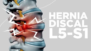 HERNIA DISCAL L5S1 síntomas y soluciones [upl. by Ajidahk646]