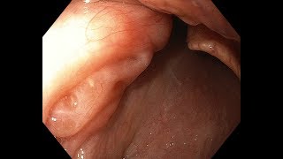 Standard EGD with OLGAOLGAIM biopsy [upl. by Yttam900]