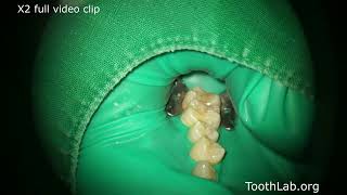 Gold Inaly Preparation Maxillary Molar [upl. by Emia]