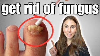 Get Rid Of Toenail Fungus With These 4 Easy Home Remedies [upl. by Naillil]