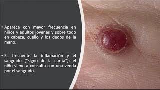 Dermatoscopia de los tumores vasculares [upl. by Uon552]