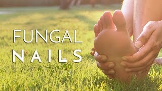 Principal Podiatrist Michael Lai Explains What Causes Fungal Toenails [upl. by Natal580]