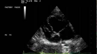 Degeneración Mixomatosa Bivalvular mitral y tricúspide  Sabu7 [upl. by Culley]