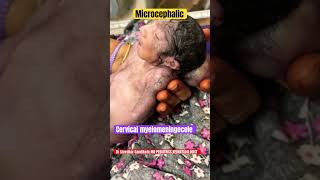 Cervical Myelomeningocele microcephaly vitaminb9 neuraltubedefects drsreedhargandikota [upl. by Halilak]