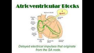 Atrioventricular Block  AV blocks made easy  AV block ECG interpretation  Types of AV Block [upl. by Hilaire]