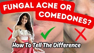 Fungal Acne VS Closed Comedones  Top 5  1 Practical Differences [upl. by Stefan]