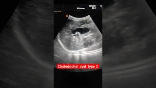 Choledochal cyst type I [upl. by Huntington]