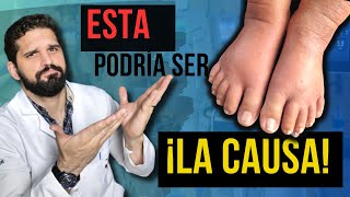 ¡MIRA ¿Por qué tus PIERNAS se HINCHAN ¡Descubre las posibles causas y SOLUCIONES✅ [upl. by Arlee]