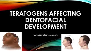 Teratogens Affecting Dentofacial Development [upl. by Tudor]