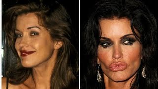 Plastic Surgery Gone Wrong Celebs Who Regret Going Under the Knife and Other Cosmetic Procedures [upl. by Aromat144]